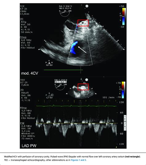 Transoesophageal Echocardiography • LITFL • CCC.